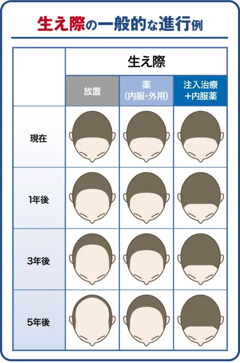 生え際の一般的な進行例と治療後のイメージ