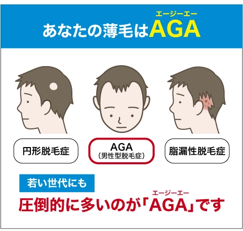 男性の薄毛で圧倒的に多いのはAGA