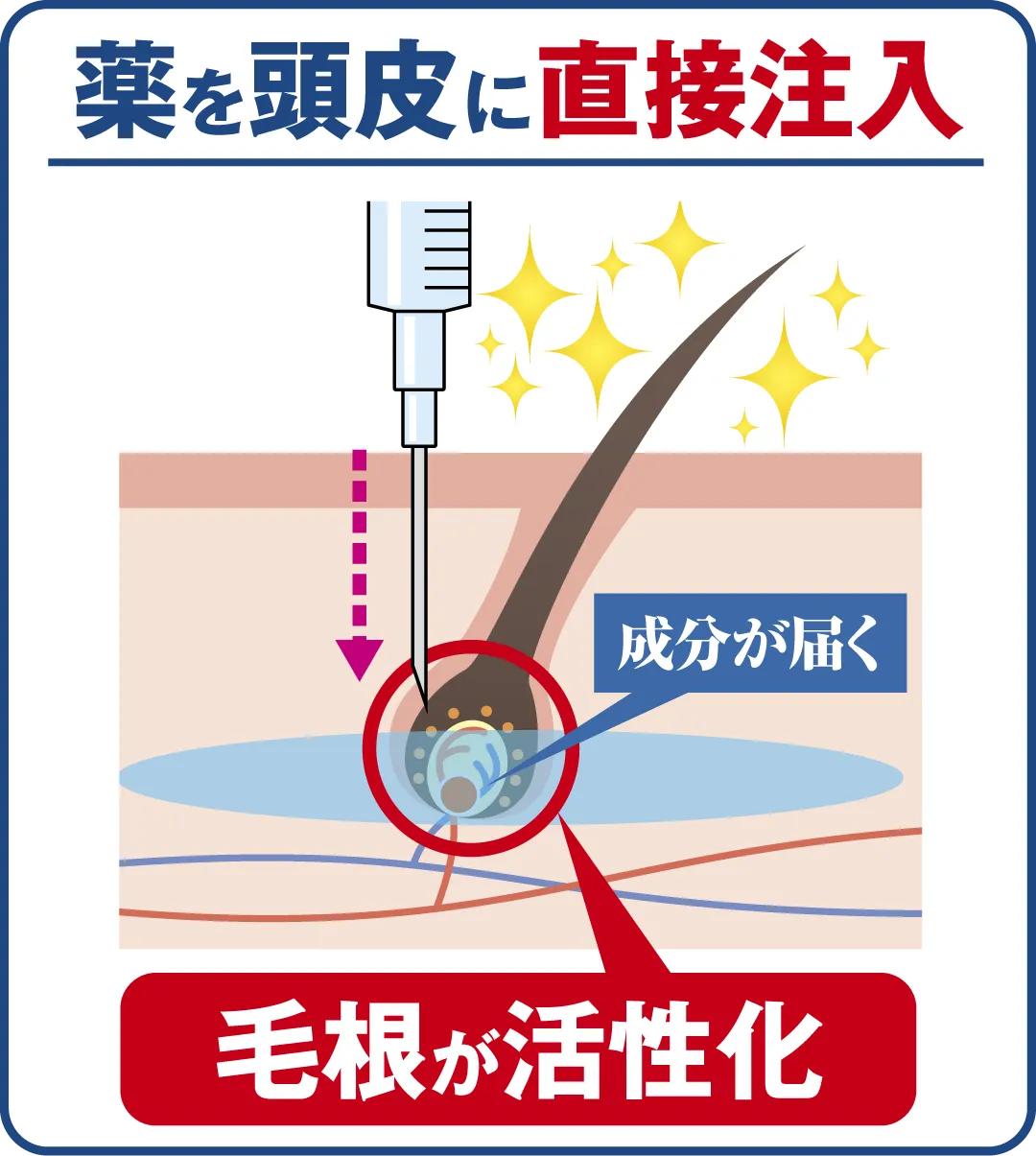 薬を頭皮に直接注入すると毛根が活性化