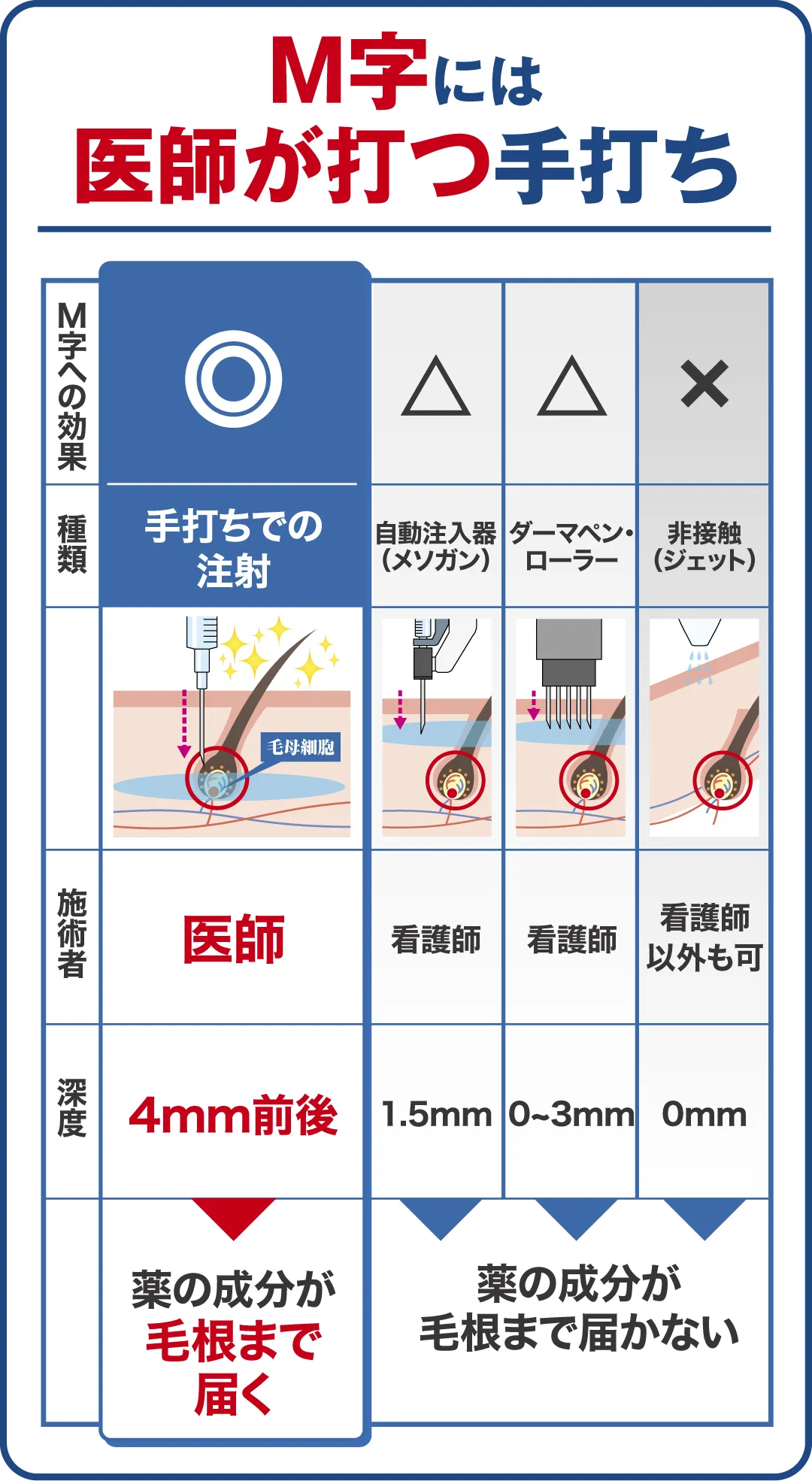 M字には医師による手打ち注入治療（深度4mm前後）で毛根まで効成分が届く