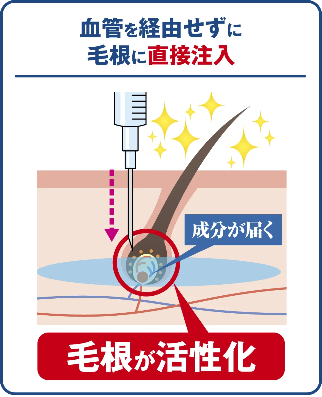 血管を経由せずに毛根へ直接注入するから毛根が活性化