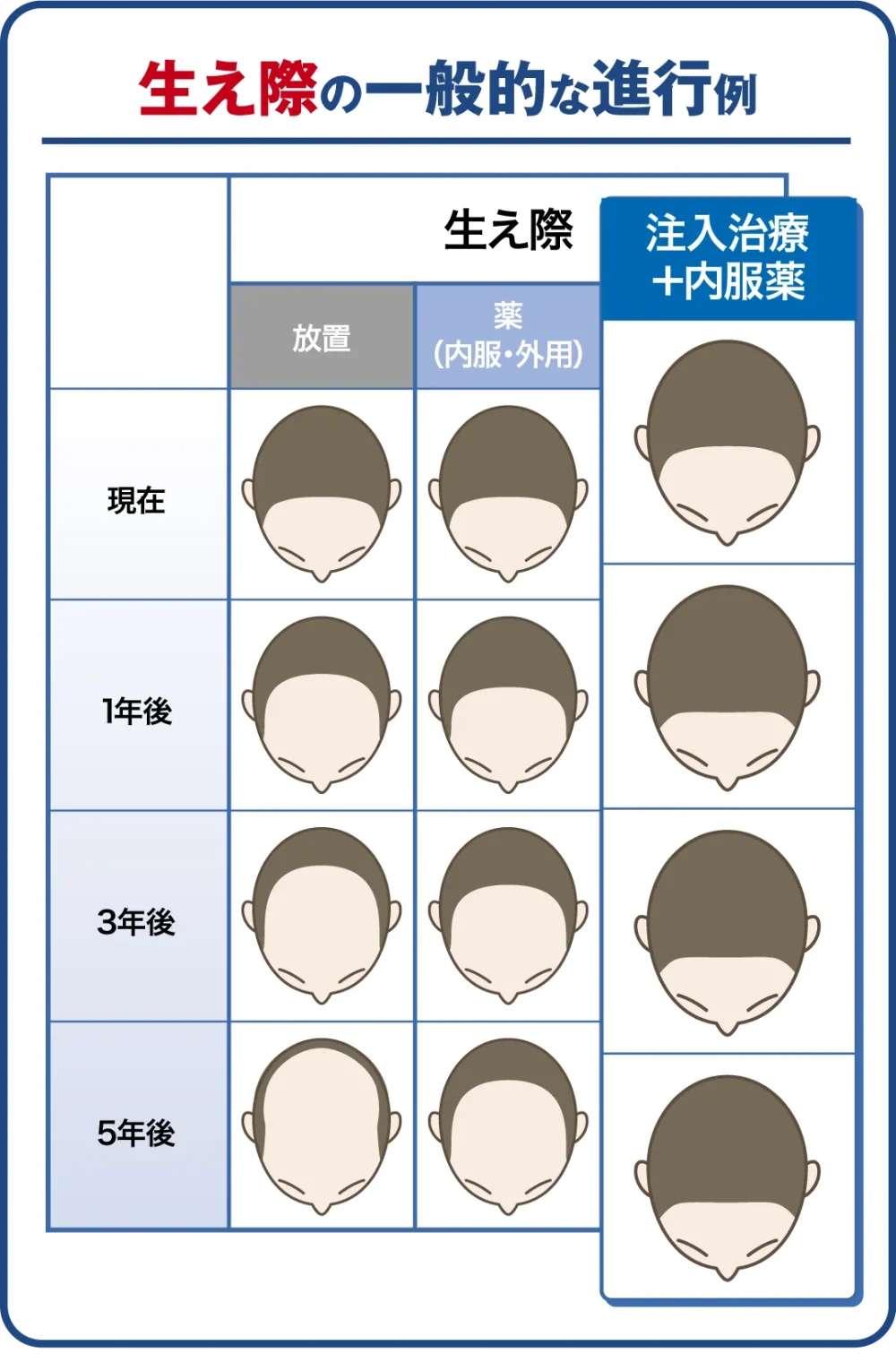 生え際の一般的な進行例と治療後のイメージ